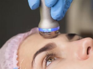 What is a radiofrequency facelift?